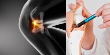 ön çapraz bağ ameliyatı (1)